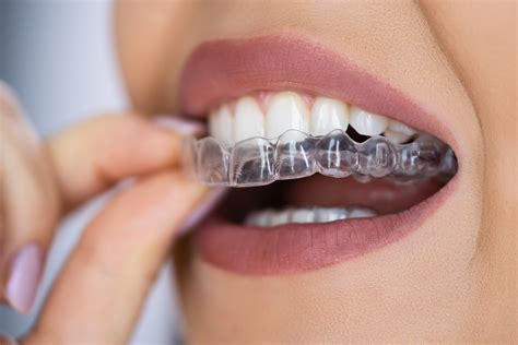 Your Guide to Dental Aligners | Discreet, Removable Solutions to ...