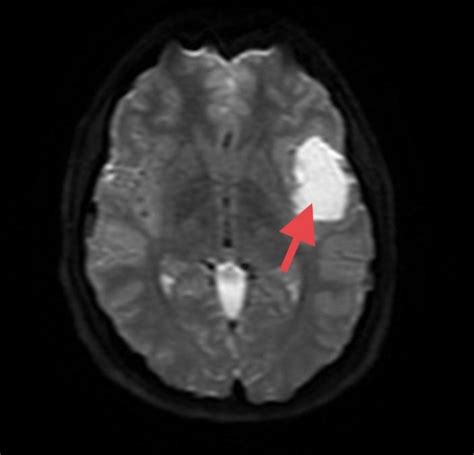 Epidermoid Cyst — Matthew Mian, MD