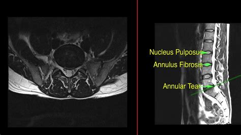 Herniated Disc Thoracic Mri