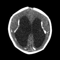 A Primer on Cortical Visual Impairment | Cortical visual impairment ...