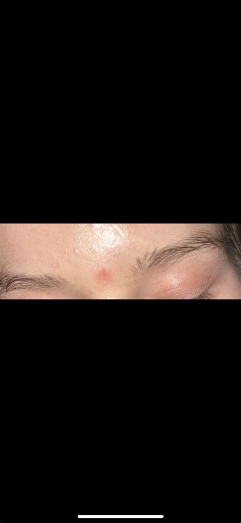 [Miscellaneous] scar after shave biopsy : r/SkincareAddiction