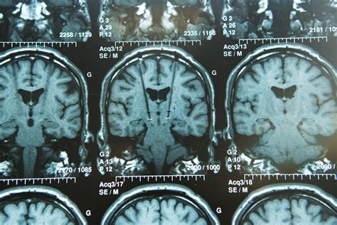 MRI in Parkinson's Patients Showed High Iron Levels in the Brain