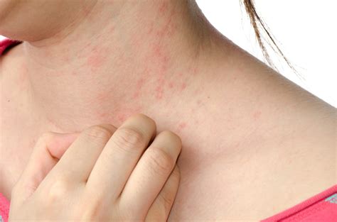 Eczema - Gupta Allergy | Allergy & Asthma Specialists