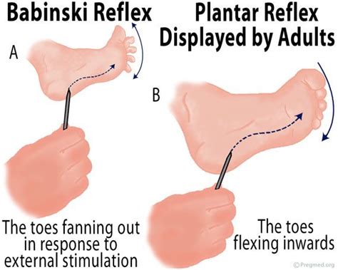 Image result for babinski reflex | Medical school stuff, Pediatric ...