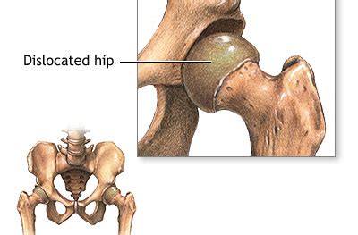 Hip Dysplasia: Symptoms, Causes Treatment, 54% OFF