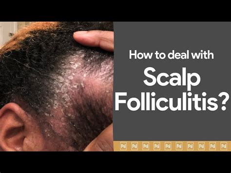 Folliculitis Scalp