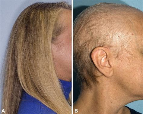 Chemotherapy-induced alopecia - Journal of the American Academy of ...