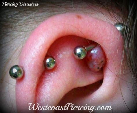 Westcoast Piercing And Ink: Large Keloid on Ear