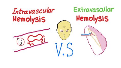 Intravascular Vs Extravascular Hemolytic Anemia; What's The ACTUAL ...