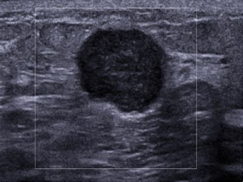 Figure 2 from Imaging features of triple negative breast carcinoma ...