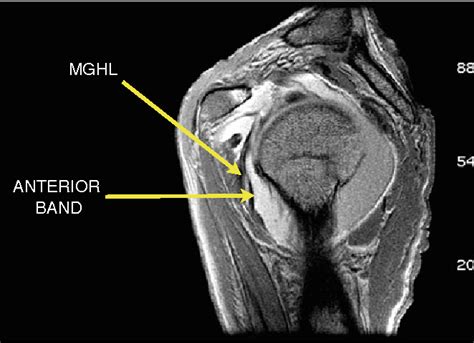 High origin of the anterior band of the inferior glenohumeral ligament ...