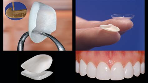 Smile Makeover with Porcelain Veneers: Are You Ready for a New Smile?