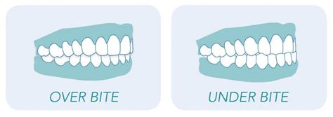 Overbite and Underbite: How to correct them?