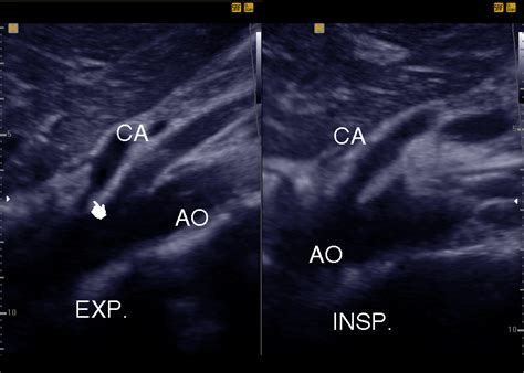 Evaluation of Asymptomatic Patients with Median Arcuate Ligament ...