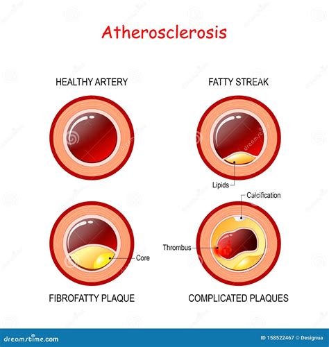 Stages of Atherosclerosis. Cholesterol in Artery Stock Vector ...