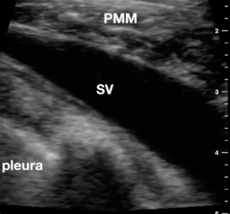 Subclavian Vein Cannulation With Ultrasound | RK.MD