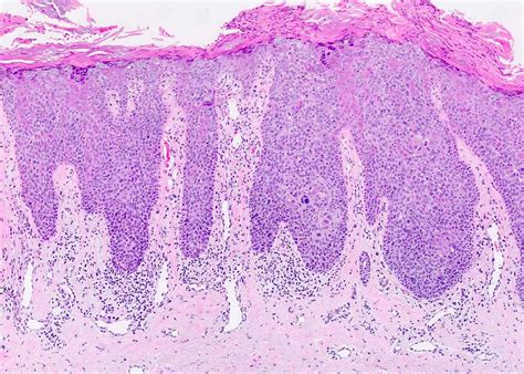 Squamous Cell Carcinoma In Situ Histology – NBKomputer