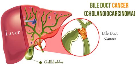 Cholangiocarcinoma - Bile Duct Cancer - Causes, Symptoms, Treatment