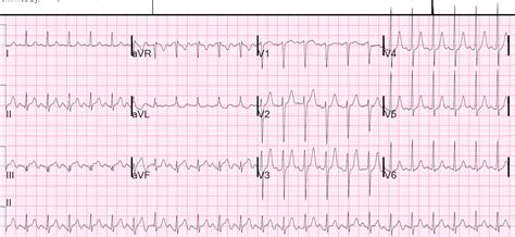 Dr. Smith's ECG Blog: Tachycardia, Dehydration, and New ST Elevation in ...