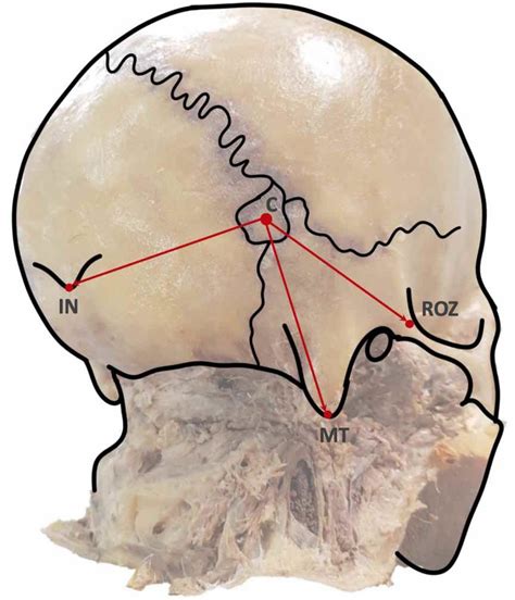 The distance from the asterion to skull landmarks (on the right side ...