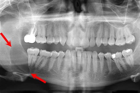 Oral Pathology: Distinguishing Cysts From Abscesses - Today's RDH