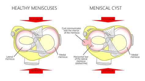 What is a Meniscal Cyst? Why You Should Care About the Hole in My ...