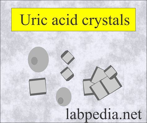 Urine Crystals (Crystalluria) - Labpedia.net