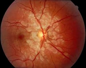 EyeRounds: Purtscher's Retinopathy (angiopathia retinae traumatica)