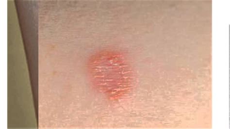 fungal skin rash - pictures, photos