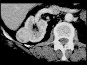 Urinary Tract and male reproductive system | 2.1 Kidney and ureter ...