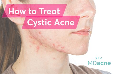 What is the best treatment for cystic acne? | MDacne