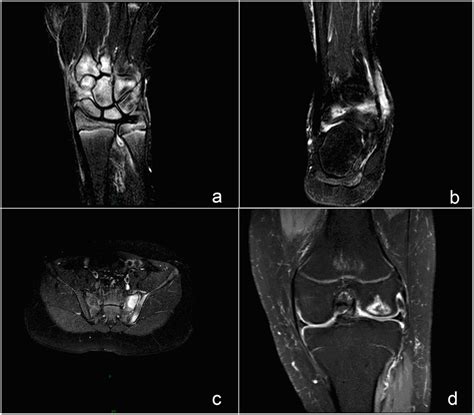 MRI findings of frequently involved joints. (a, b, c and d) Bone marrow ...