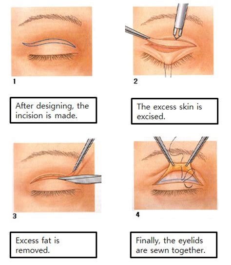 Double Eyelid Surgery Makeup - Mugeek Vidalondon