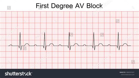 11 張 First degree av block 圖片、庫存照片和向量圖 | Shutterstock