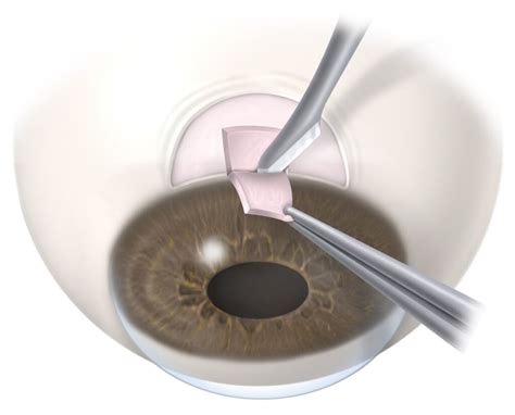 Glaucoma Surgery - Jayadeva