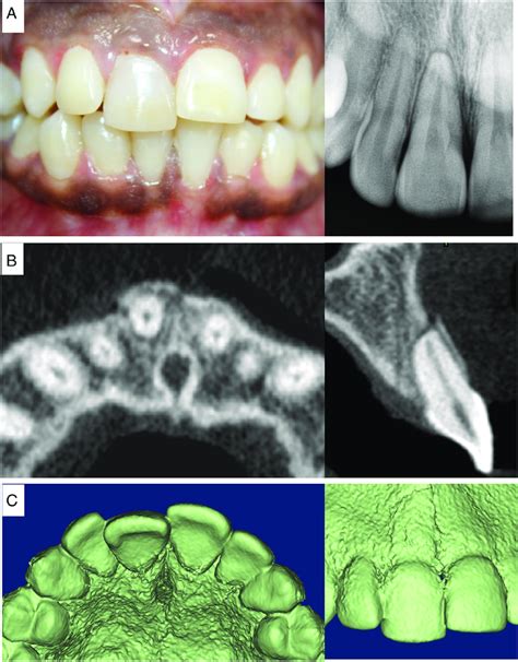 -A, The clinical photograph and radiograph showing a lateral luxation ...