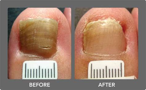 Home Remedies to Treat Nail Fungus PERMANENTLY | StethNews