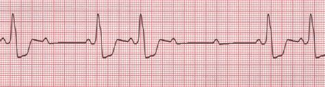 Understanding Atrioventricular Blocks | ACLS.com