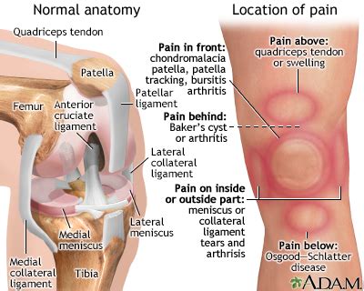 Knee Pain - Symptoms and Causes