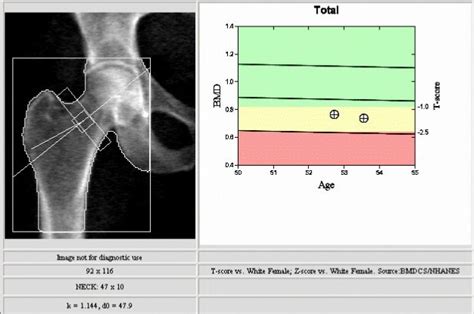 Understanding Your Bone Density Scan Results