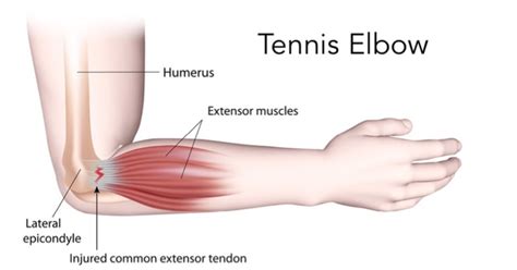 Tennis Elbow – what causes it, symptoms and treatment – Body ...