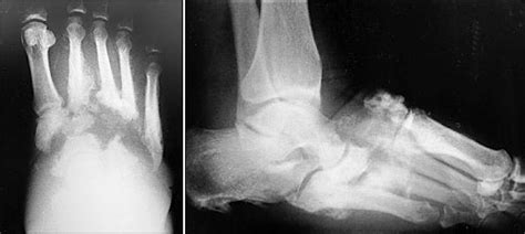 Charcot Foot Syndrome (or neuropathic arthropathy)