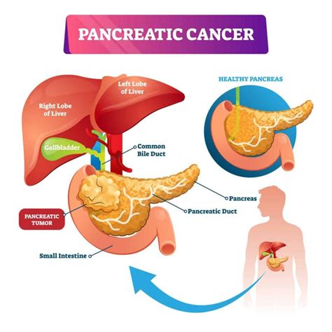 Pancreatic cancer illustration - Medicare Solutions Blog