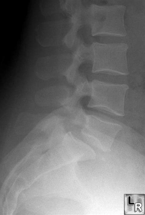 Learning Radiology - Spondylolesthesis