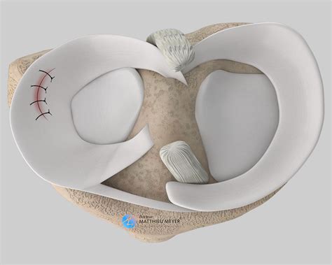 Arthroscopic Meniscal Surgery - Doctor Matthieu Meyer