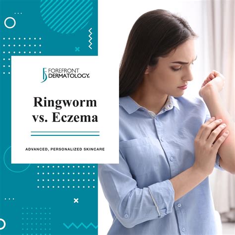 Ringworm Vs Eczema - Forefront Dermatology