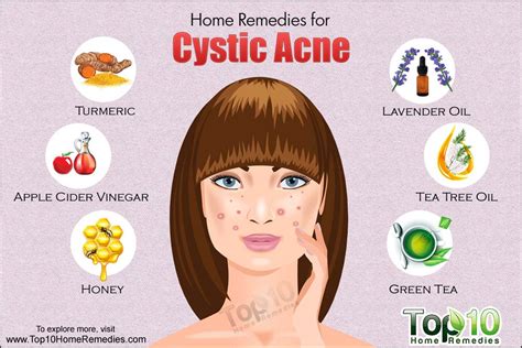 Home Remedies To Get Rid Of Lice: Home Remedies Cystic Acne