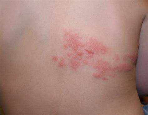 Shingles Rash Pictures