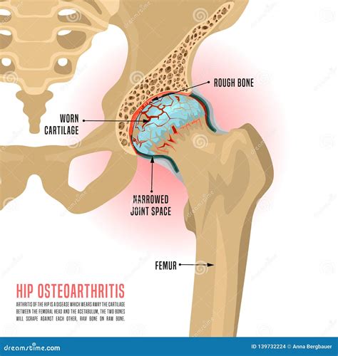 Hip Osteoarthritis Infographic Vector Illustration | CartoonDealer.com ...