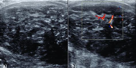 Heterogeneous Thyroid Ultrasound